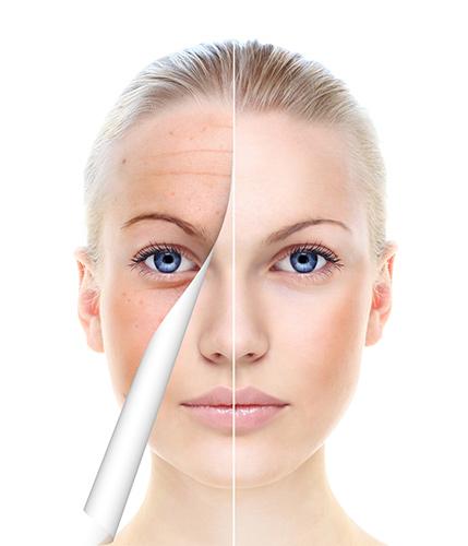 Microdermabrasie-3